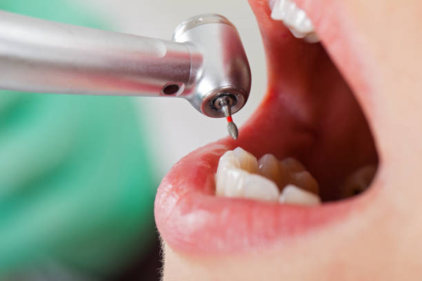 Best Emergency Root Canal Treatment in Rosemont, CA